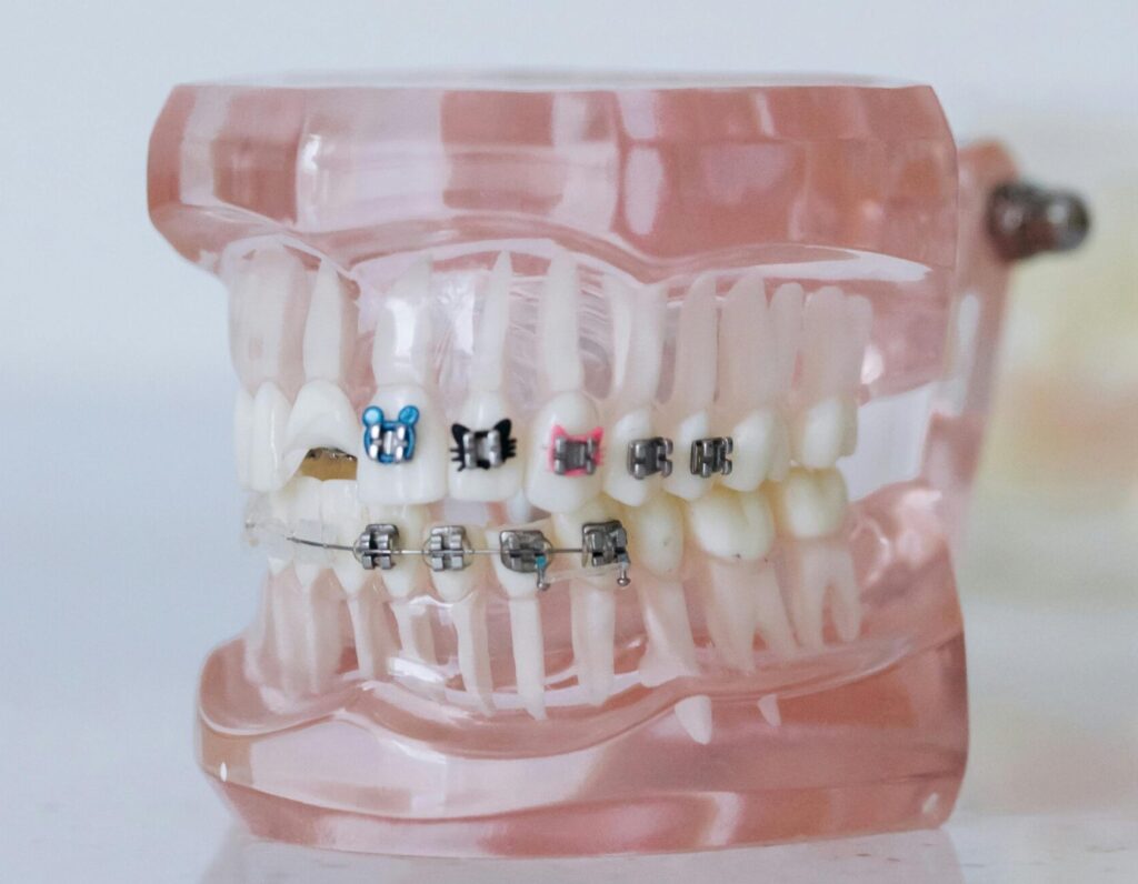 Close-up of a dental model showcasing braces in a clinical setting.